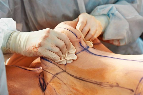 Abdominoplastie à Paris : le point sur la chirurgie complète