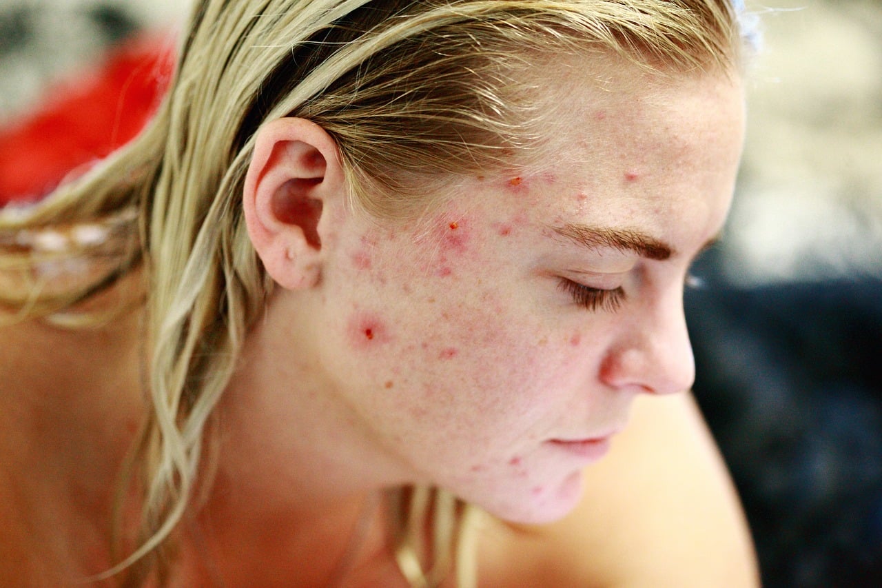 struggle, acne, self love